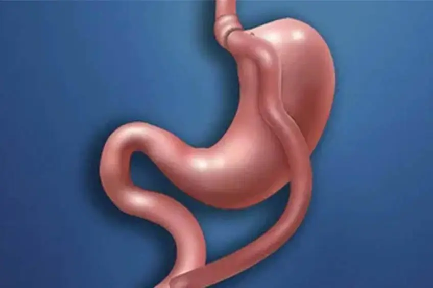 Gastrik bypass ameliyatı (Mide Bypass)